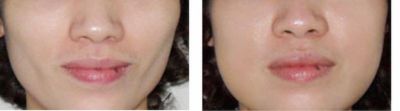 CẤY GHÉP MỠ TỰ THÂN – PHƯƠNG PHÁP LÀM ĐẸP HIỆN ĐẠI CẤY GHÉP MỠ TỰ THÂN – PHƯƠNG PHÁP LÀM ĐẸP HIỆN ĐẠI