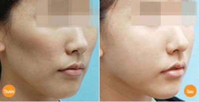 CẤY GHÉP MỠ TỰ THÂN – PHƯƠNG PHÁP LÀM ĐẸP HIỆN ĐẠI