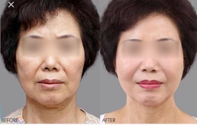 CẤY GHÉP MỠ TỰ THÂN – PHƯƠNG PHÁP LÀM ĐẸP HIỆN ĐẠI CẤY GHÉP MỠ TỰ THÂN – PHƯƠNG PHÁP LÀM ĐẸP HIỆN ĐẠI