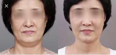 CẤY GHÉP MỠ TỰ THÂN – PHƯƠNG PHÁP LÀM ĐẸP HIỆN ĐẠI