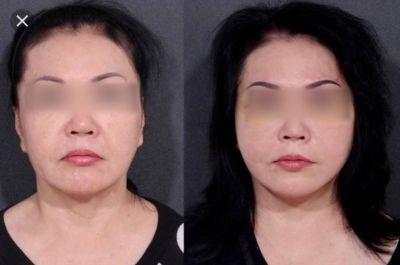 CẤY GHÉP MỠ TỰ THÂN – PHƯƠNG PHÁP LÀM ĐẸP HIỆN ĐẠI