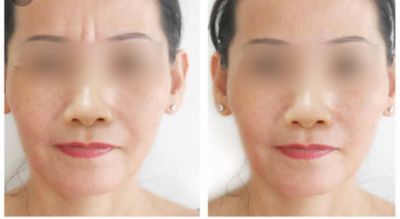 CẤY GHÉP MỠ TỰ THÂN – PHƯƠNG PHÁP LÀM ĐẸP HIỆN ĐẠI