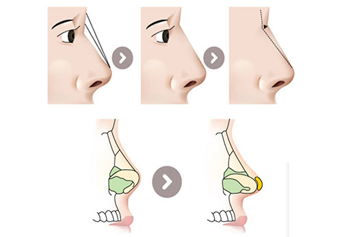 NÂNG MŨI HÀN QUỐC