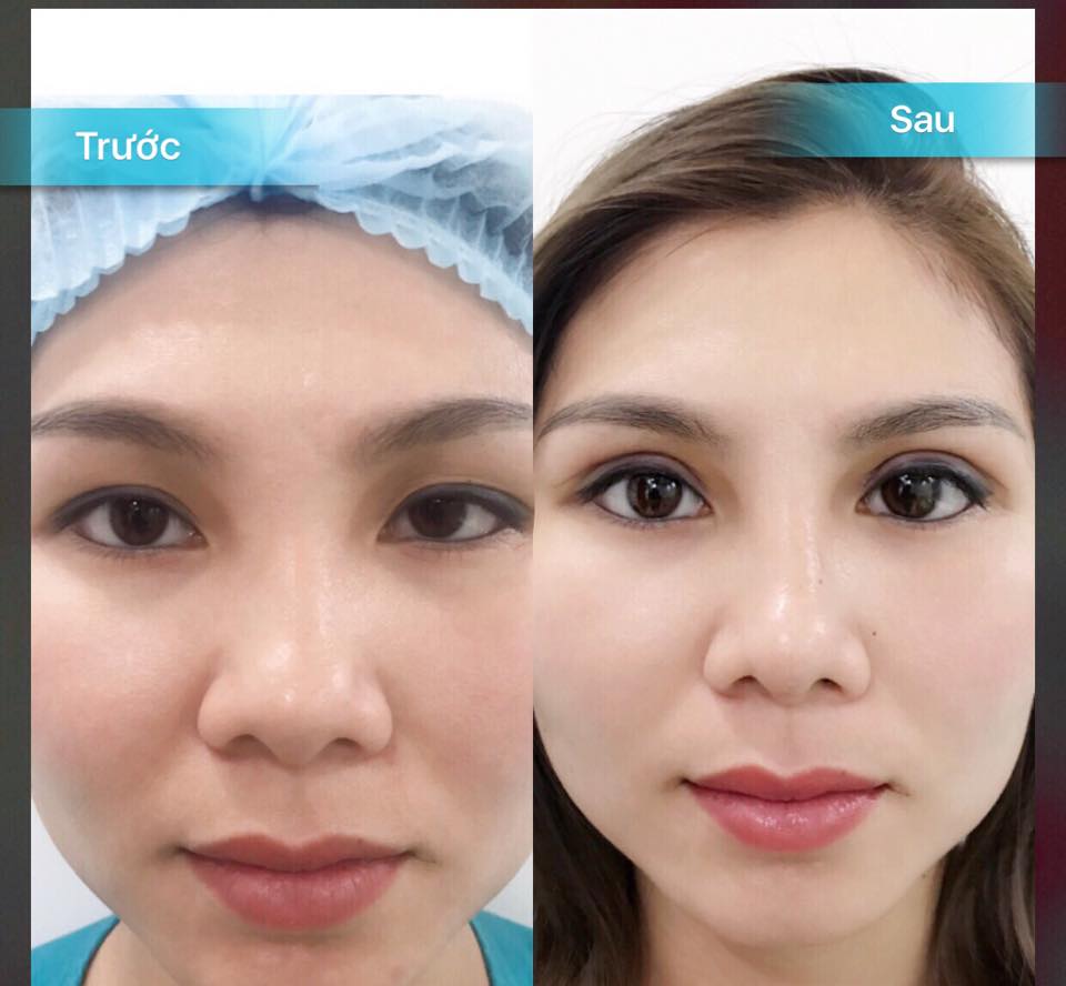 Công nghệ độc quyền cắt mí Ấn Độ