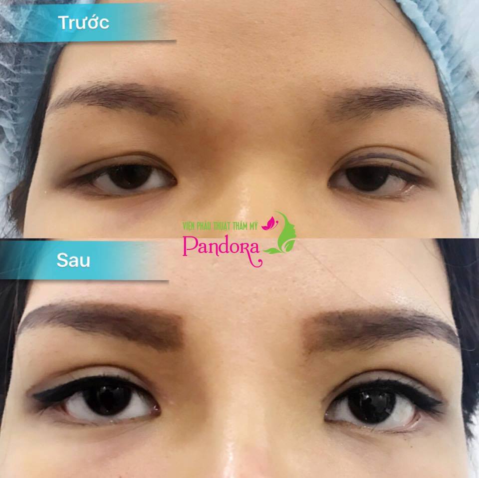 Cắt mí trên xử lý hết sụp mí do bẩm sinh