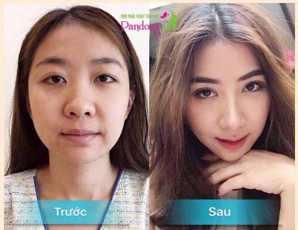 Cắt mí ấn độ