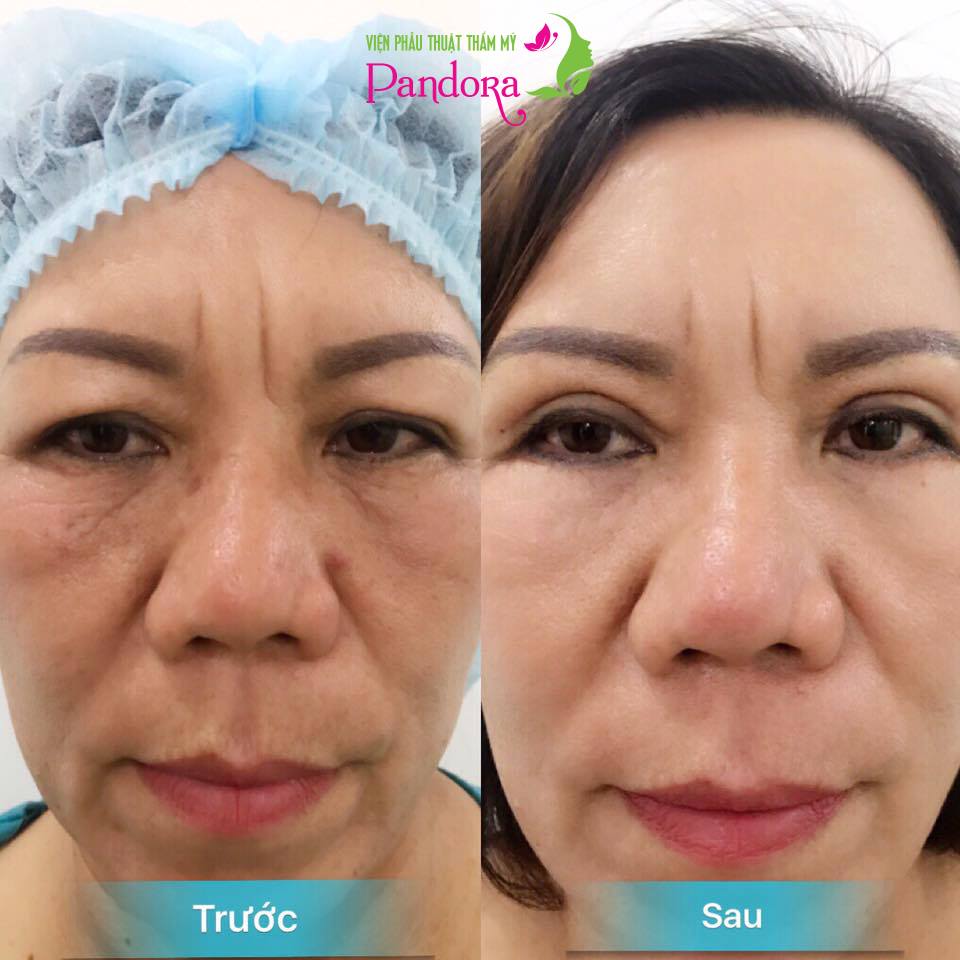 Phẫu thuật cắt mí trên và mí dưới