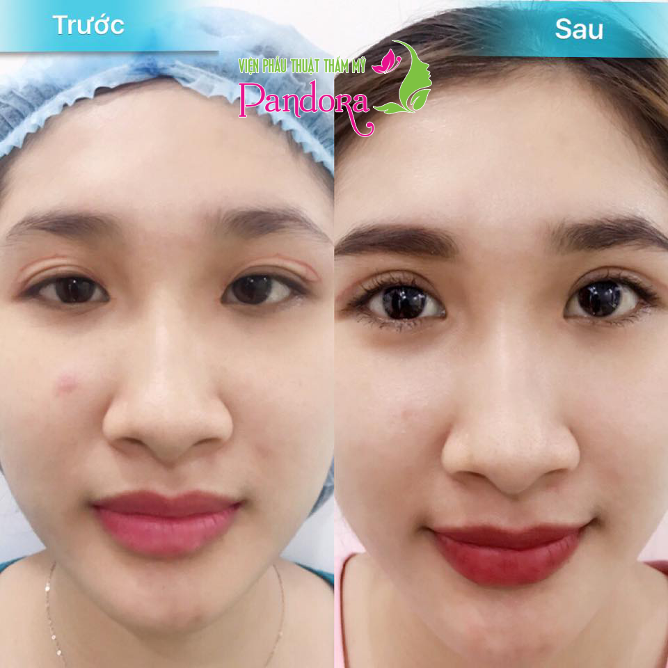 Cắt mí