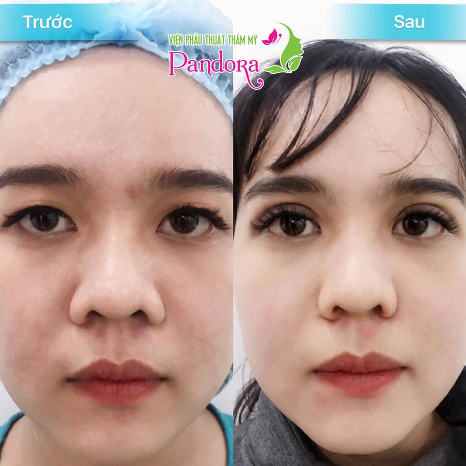 CN độc quyền cắt mí Ấn Độ