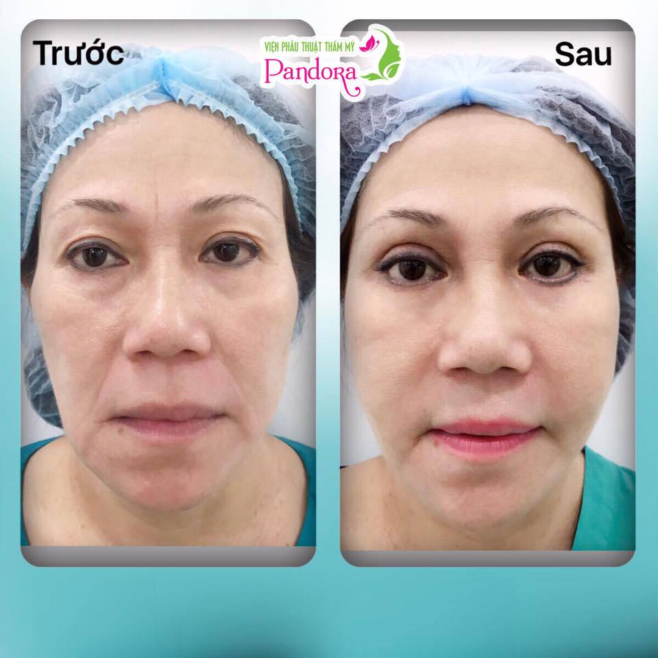 cấy mỡ toàn bộ khuôn mặt