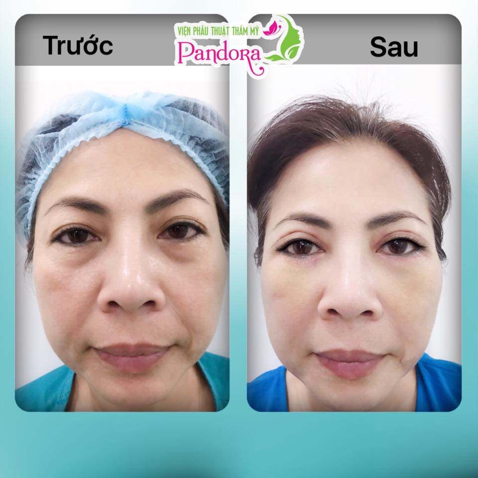 Cắt mí trên & mí dưới