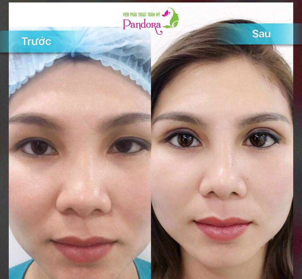 CN độc quyền cắt mí Ấn Độ