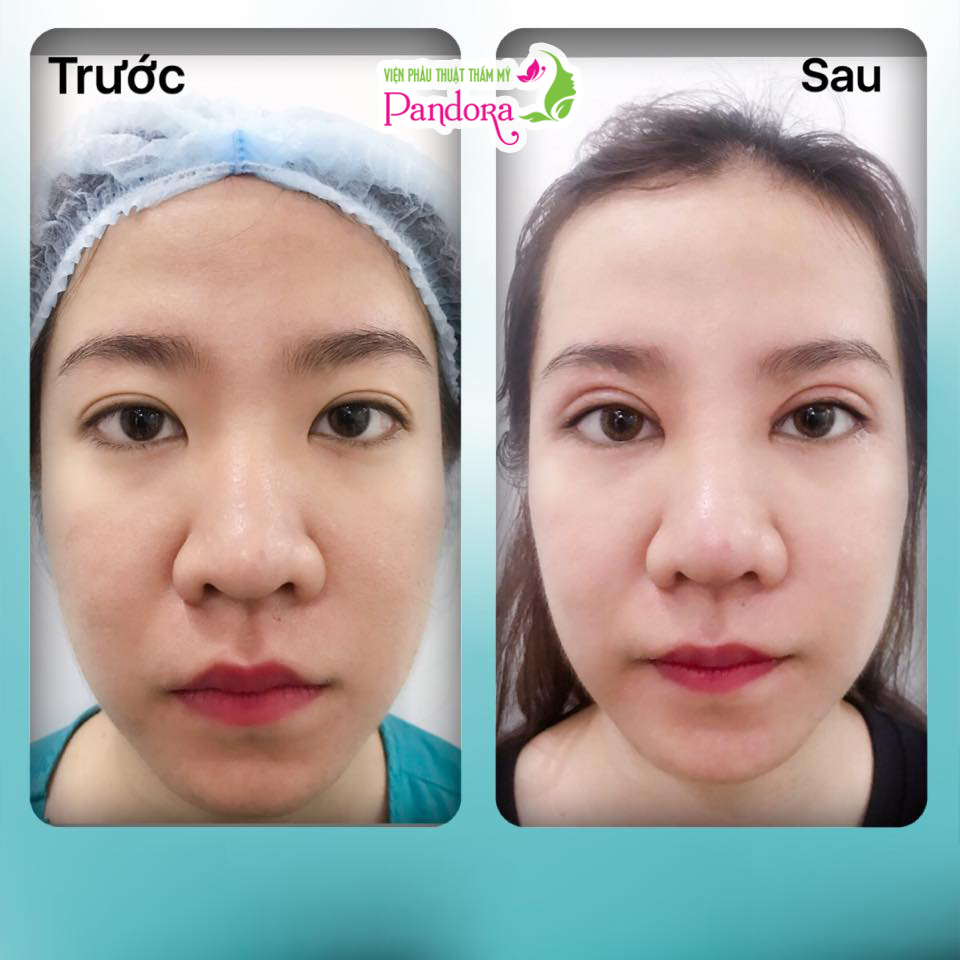 CN độc quyền cắt mí Ấn Độ