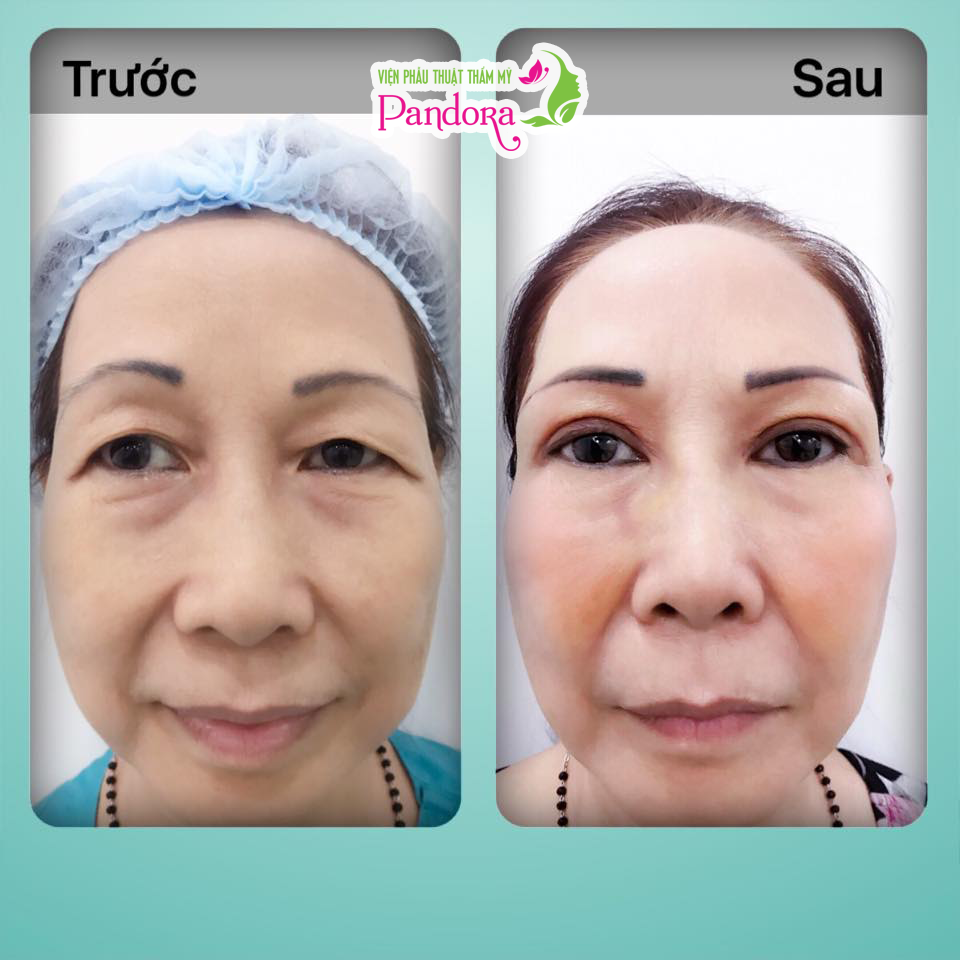 Cắt mí trên & mí dưới