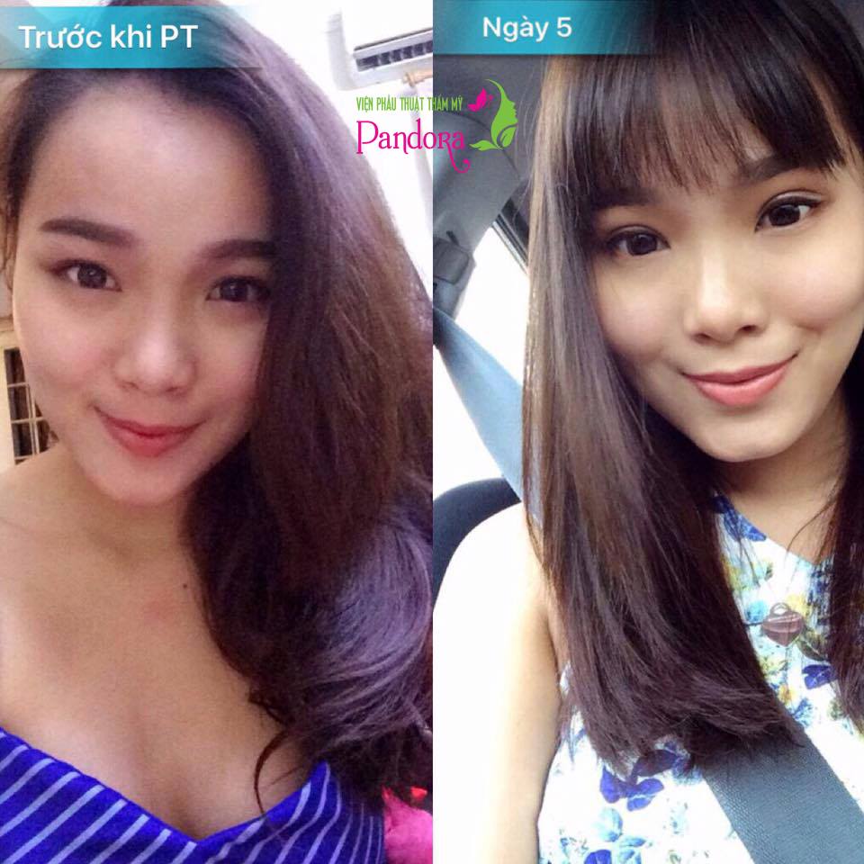 Nhấn mí Double Eyelid áp dụng CN của HQ