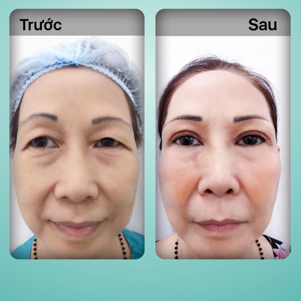 Cắt mí trên & mí dưới