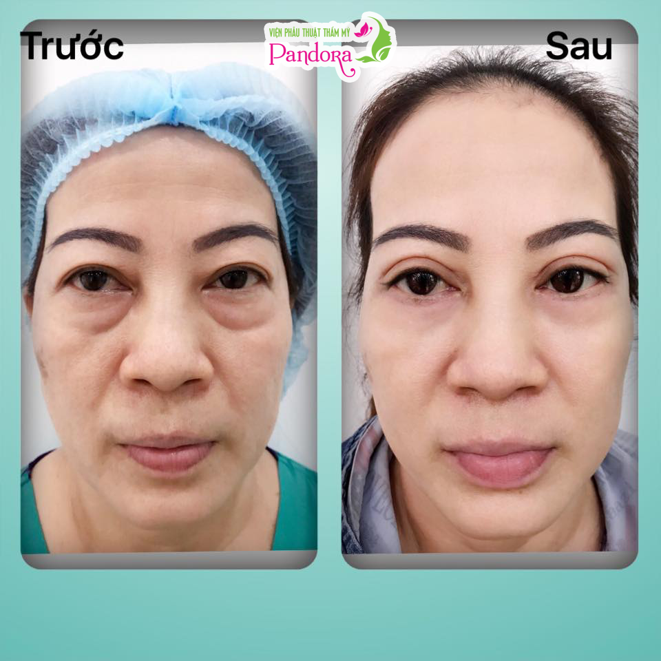 Cắt mí trên & mí dưới