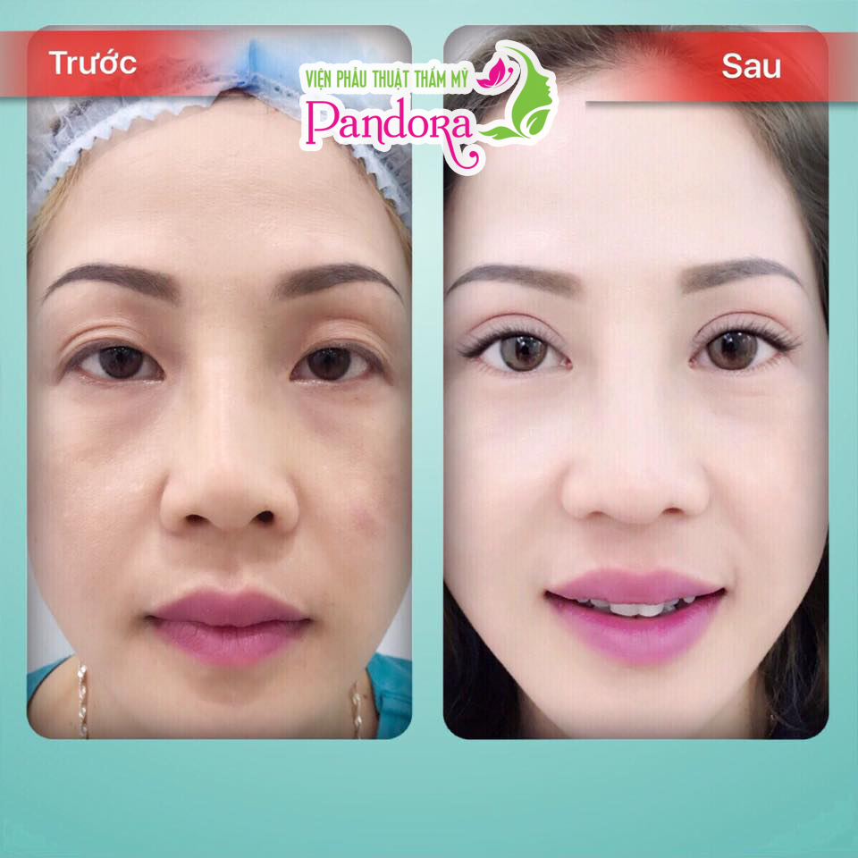 CN độc quyền cắt mí Ấn Độ