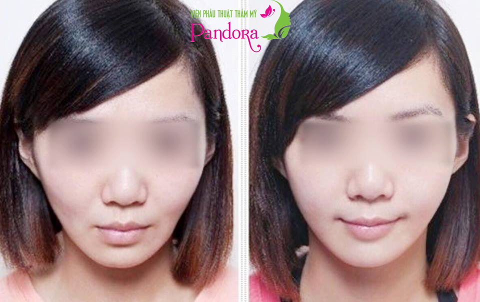 Cấy mỡ tự thân làm đầy má hóp