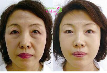 cấy mỡ toàn bộ khuôn mặt