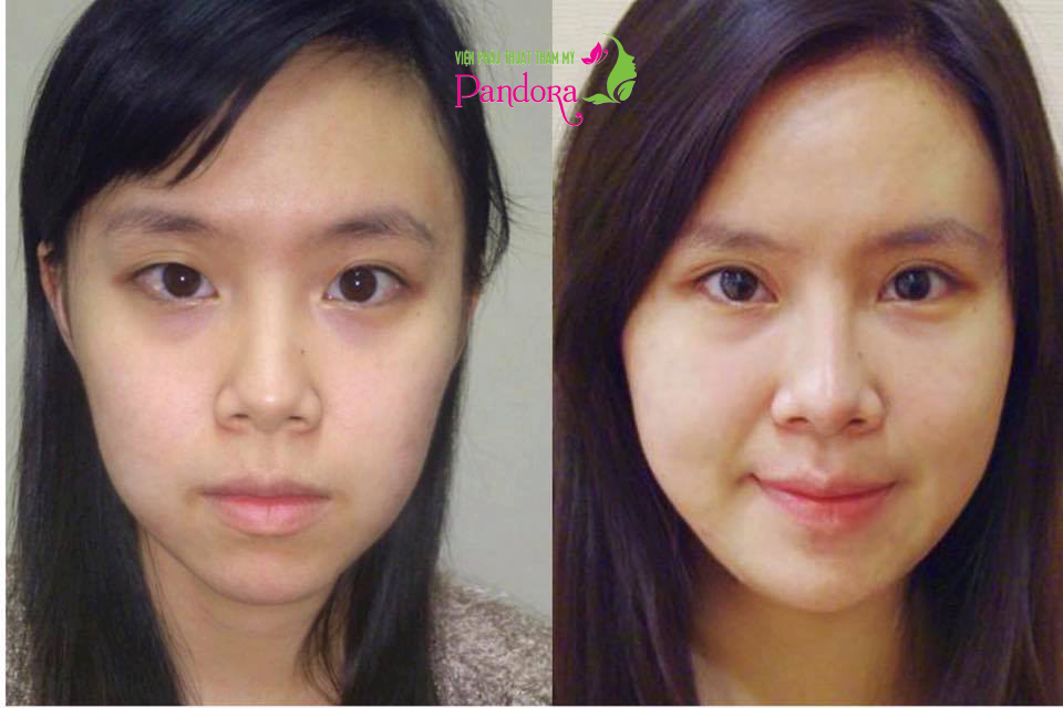 Cấy mỡ tự thân làm đầy má hóp