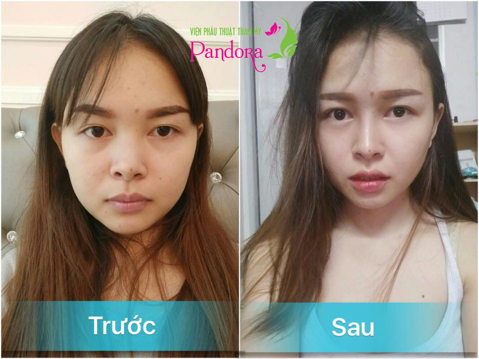 Hút mỡ 2 bên má bầu