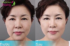 Cấy mỡ làm đầy & và xoá vết nhăn trũng 2 bên khoé miệng cười