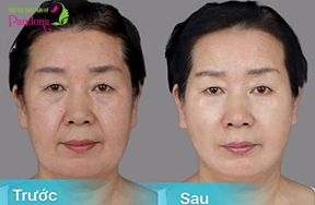 Cấy mỡ làm đầy & và xoá vết nhăn trũng 2 bên khoé miệng cười