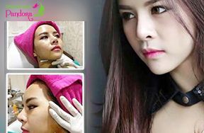 Cấy tế mỡ tự thân làm trẻ hoá, căng da