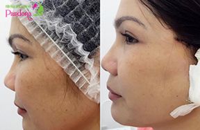Căng da toàn bộ khuôn mặt, xóa nhăn