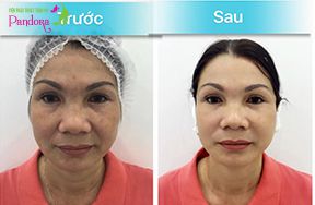 Căng da toàn bộ khuôn mặt, xóa nhăn