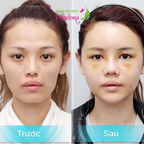 Cấy mỡ tự thân làm đầy má hóp