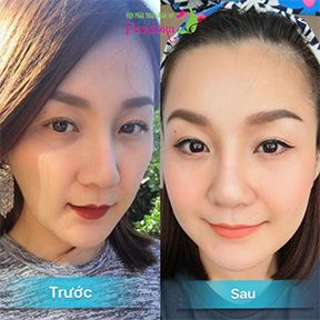 Cấy mỡ tự thân toàn bộ khuôn mặt.