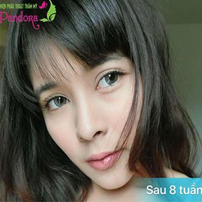 Cấy mỡ tự thân làm đầy 2 má hóp