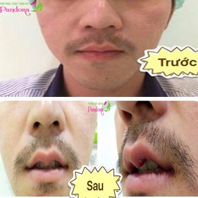 Tạo hình môi trái tim