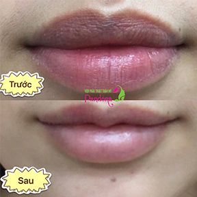 Phẫu thuật thu nhỏ & tạo hình môi trái tim
