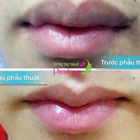 Tạo hình môi trái tim
