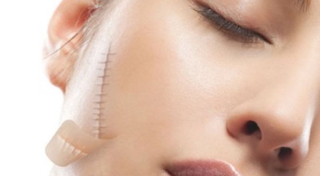 PHẪU THUẬT ĐIỀU TRỊ SẸO LỒI, SẸO XẤU
